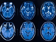 Estudios de imagen confirman cambios en el cerebro después de padecer covid-19