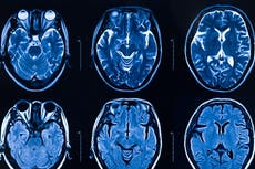 Estudios de imagen confirman cambios en el cerebro después de padecer covid-19