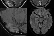 Hallan larvas en el cerebro de una mujer tras sufrir dolores de cabeza