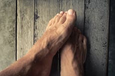 Dedos covid: ¿Qué es el sabañón y cuáles son los síntomas?