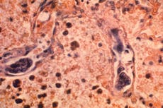 EEUU registra nueva caída récord en muertes por cáncer