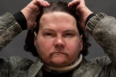 Hombre de Nueva Jersey recibe trasplante de rostro y manos