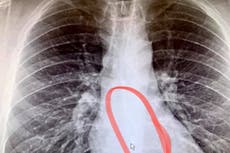 Massachusetts: Hombre traga uno de sus AirPods sin darse cuenta mientras dormía