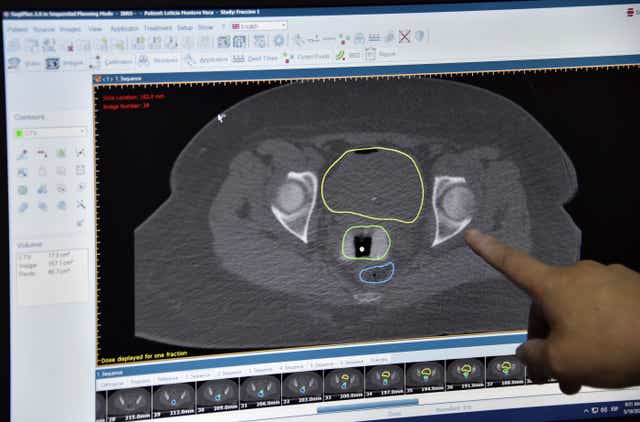Una doctora señala una pantalla con las pruebas de una paciente con cáncer de cuello uterino durante su primera sesión de braquiterapia 3D de alta frecuencia en el Instituto Boliviano de Radioterapia y Oncología (IBRO) en El Alto, Bolivia.