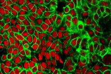 Expertos aconsejan exámenes de cáncer de colon desde 45 años