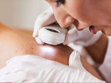 Los síntomas más comunes de cáncer de piel que pueden pasar desapercibidos