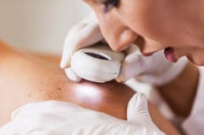 Científicos buscan nuevos tratamientos para la forma más peligrosa del cáncer de piel