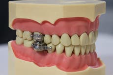 Organizaciones benéficas denuncian “dispositivo de pérdida de peso” que bloquea la mandíbula