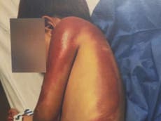 Demandan a Peloton después de que un niño de tres años quedara con quemaduras causadas por una caminadora