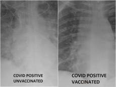 Radiografías muestran la diferencia del efecto de COVID en pacientes vacunados y no vacunados
