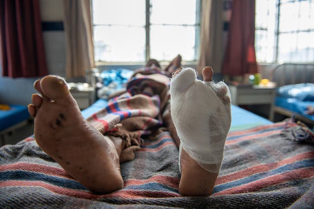<p>Chile no ha reportado un caso de lepra desde 2017 </p>