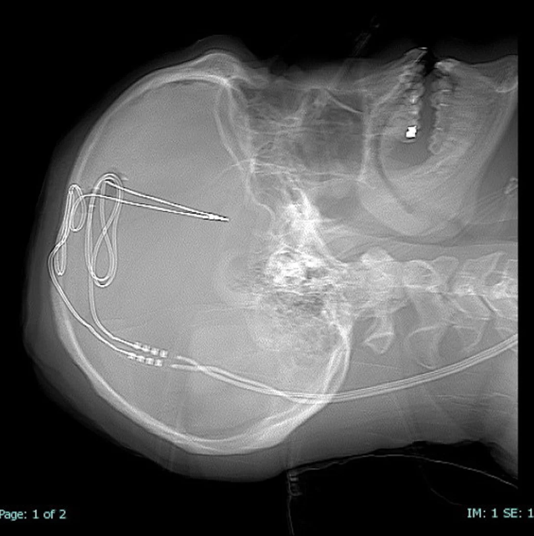 Médicos de EE. UU. están probando una cirugía cerebral para detener la adicción a los opioides