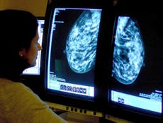 Mujeres jóvenes con cáncer de mama tienen mayor riesgo de metástasis
