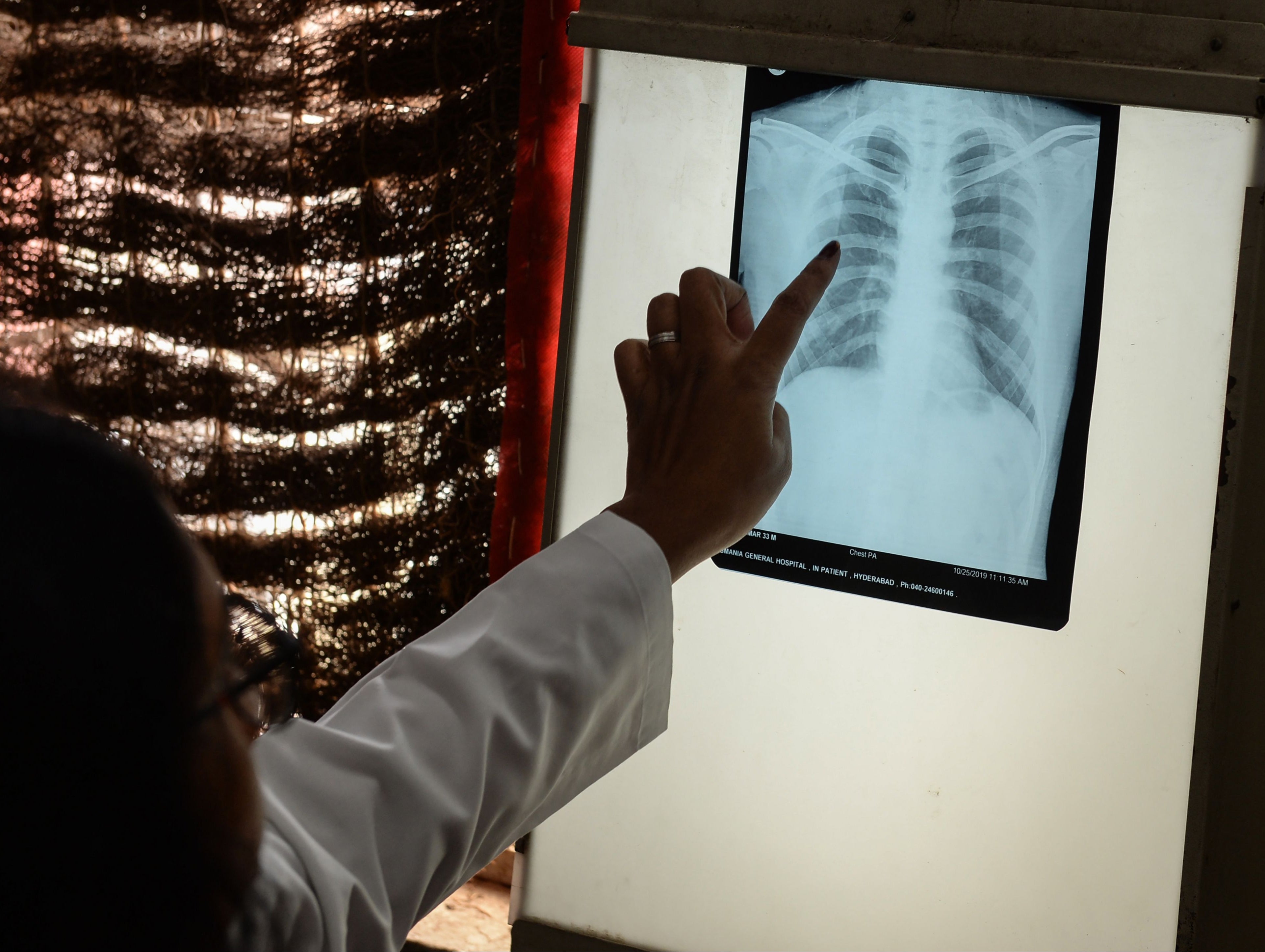 Un médico revisa la radiografía de tórax de un paciente en el departamento de tuberculosis (TB) del Hospital General de Osmania en Hyderabad, India, el 30 de octubre de 2019