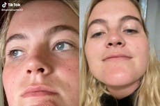 Mujer muestra infección en el mentón causada por besar a un hombre con barba incipiente