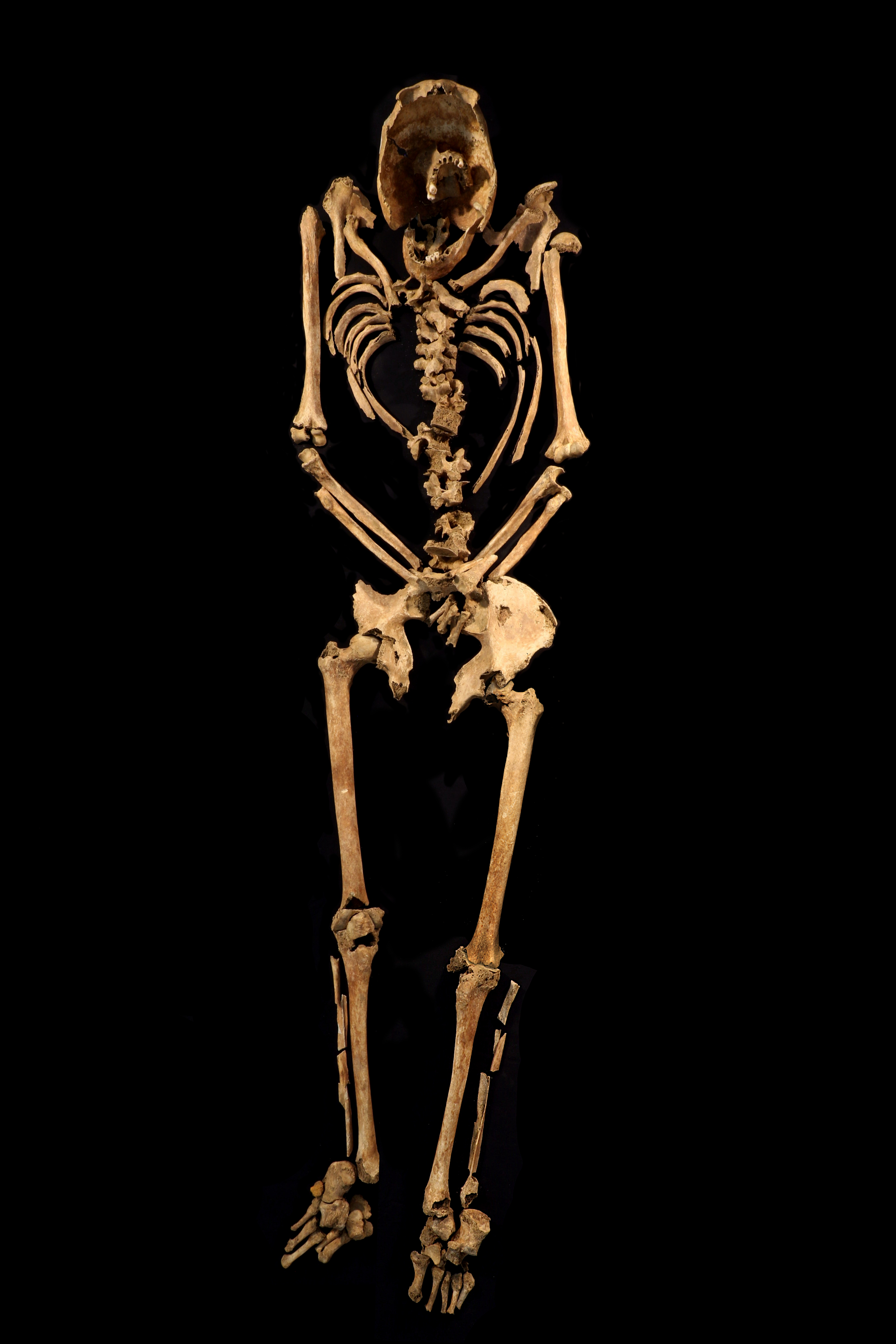 El esqueleto revela huesos fracturados, pérdida de dientes y artritis degenerativa
