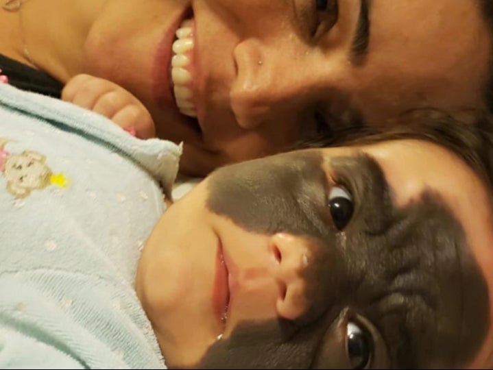 Quitan lunar “de Batman” a niña de dos años con innovadora cirugía rusa