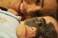 Quitan lunar “de Batman” a niña de dos años con innovadora cirugía rusa