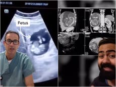 Historia de una mujer se vuelve viral después de que se descubrió que un bebé crecía dentro de su hígado