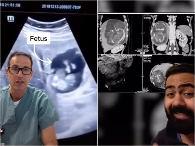 Una mujer se volvió viral en TikTok después de que los médicos encontraron un bebé creciendo en su hígado