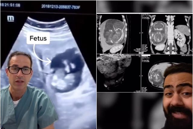 Una mujer se volvió viral en TikTok después de que los médicos encontraron un bebé creciendo en su hígado