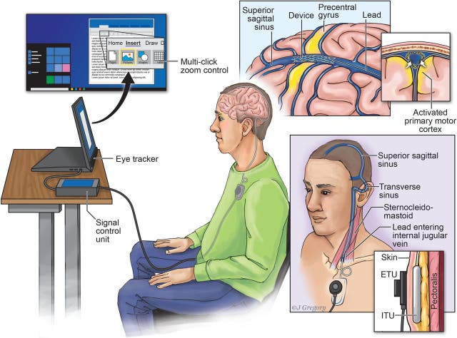El dispositivo Stentrode de Synchron permite la comunicación directa entre un cerebro humano y una computadora, sin necesidad de teclear o hablar