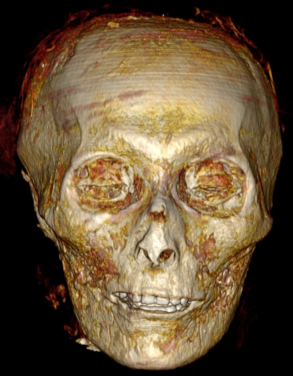 CT que muestra los dientes de oro “bien conservados” de Amenhotep