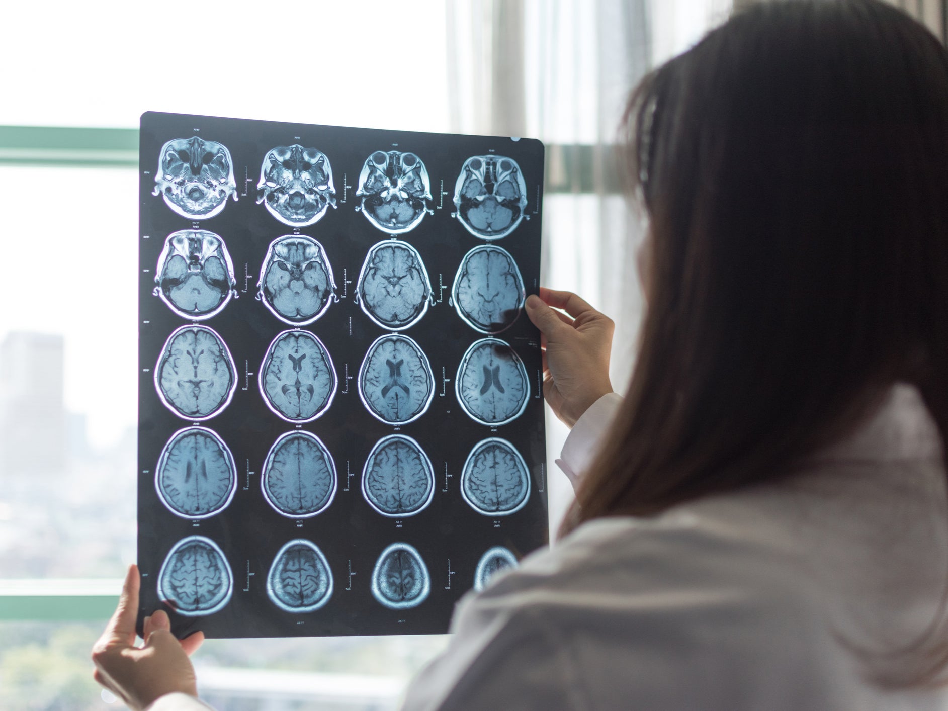 Esclerosis múltiple: ¿Cuáles son los síntomas y cómo se trata?