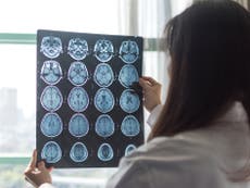 Mujer acude al médico para operación de vesícula y le detectan tumor en el cerebro