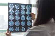 ¿Cuáles son los síntomas de un derrame cerebral y cómo se puede prevenir?