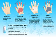 ¿Cuánto frío debe hacer para sufrir una congelación y con qué rapidez se produce?