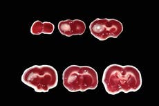 Científicos usan diminutas “semillas” de metal para calentar y matar el cáncer