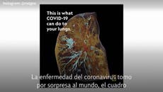 Este es el daño a los pulmones después de padecer el coronavirus