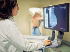Estudio sugiere que la detección temprana del cáncer de mama podría reducir la mitad de las muertes