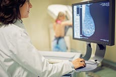 Estudio sugiere que la detección temprana del cáncer de mama podría reducir la mitad de las muertes