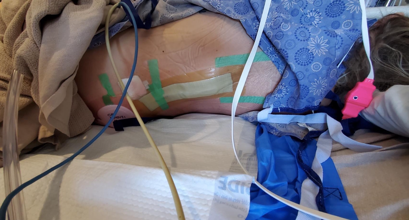 Jordan Hatmaker (35 años) muestra las lesiones a su columna en el hospital