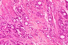 Médicos piden renombrar el cáncer de próstata de bajo grado