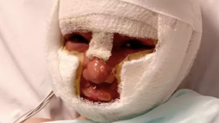 Dominick Krankall en el hospital recuperándose de un peligroso incidente de quemaduras que dejaron sus pequeños miembros y cara llenos de heridas