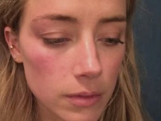 La abogada de Johnny Depp acusó a Amber Heard de retocar las fotos de su cara con heridas como la de arriba
