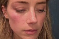 Amber Heard es acusada de retocar fotografías de heridas tras pelear con Johnny Depp