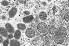 Viruela del mono: ¿Dónde está la enfermedad? ¿Se extenderá en EE.UU.?