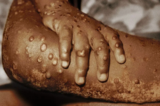 ¿Qué es la viruela del mono y qué riesgos tiene para la salud?