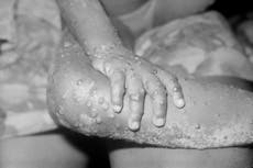 Viruela del mono: hacen llamado urgente a virólogos voluntarios tras aumento de casos en el Reino Unido