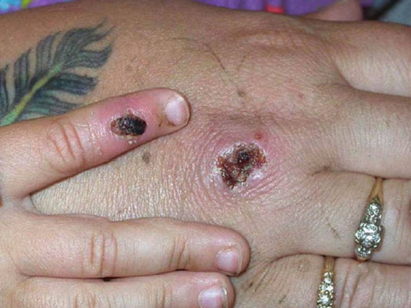 Paciente de Nueva York da positivo a virus relacionado con la viruela del mono