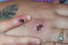 Paciente de Nueva York da positivo a virus relacionado con la viruela del mono