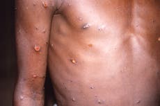 México enciende alertas epidemiológicas por viruela del mono