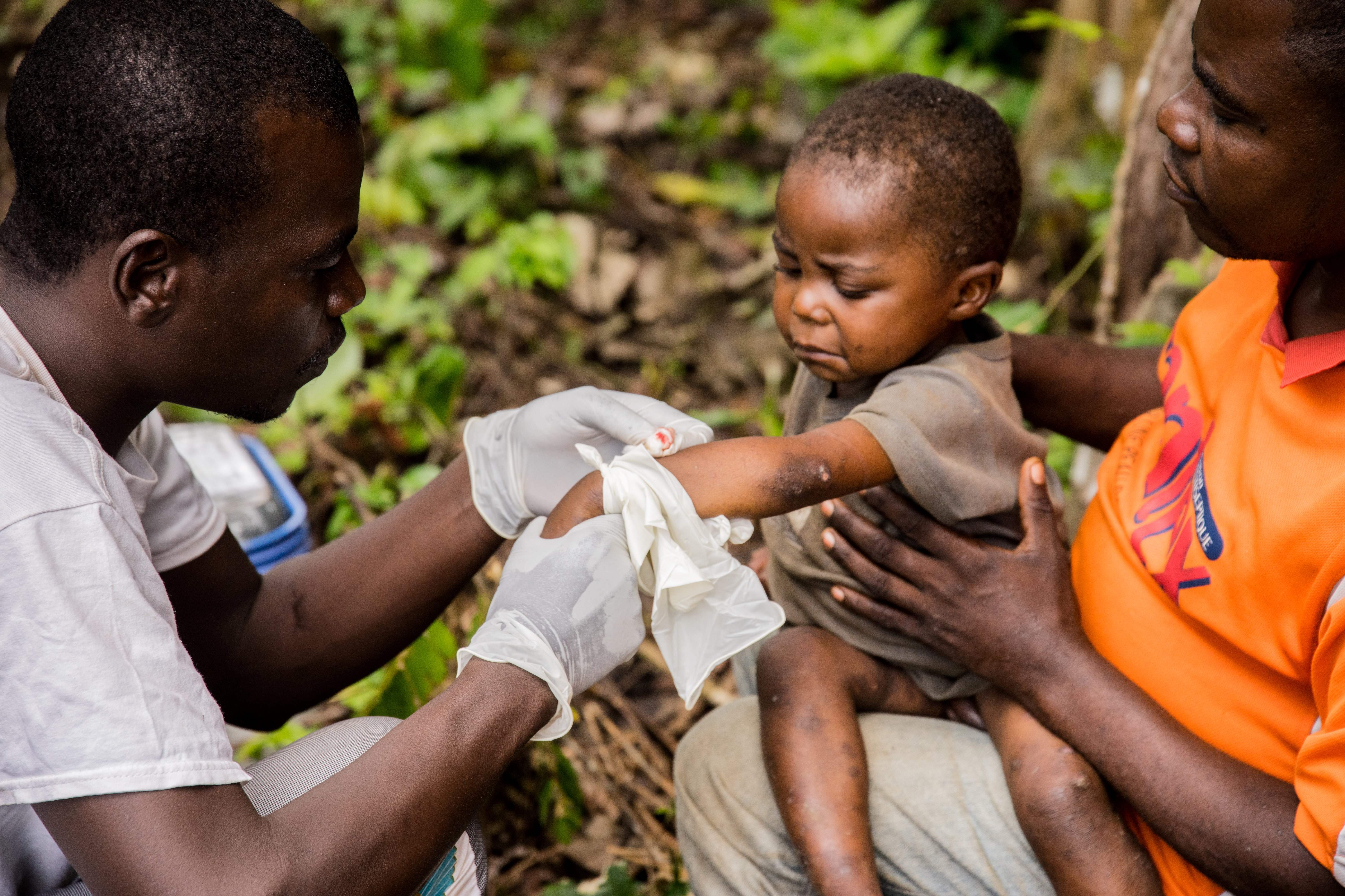 Un niño que padece viruela del mono recibe tratamiento durante un brote previo en la República Africana Central, en 2018