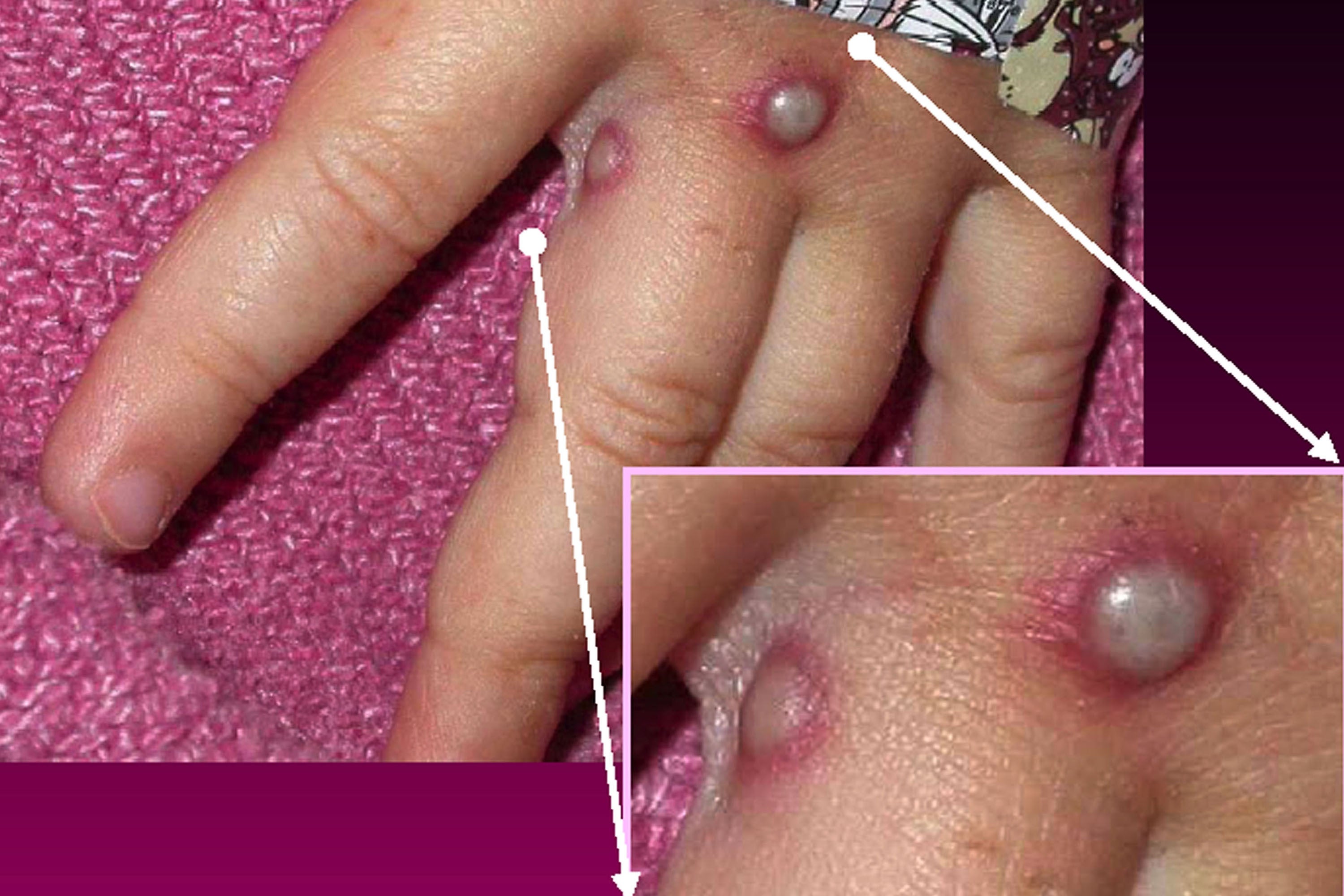 Primeros signos de la infección por viruela del mono en la mano de un paciente