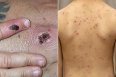 Viruela del mono: ¿En qué es diferente de la varicela?