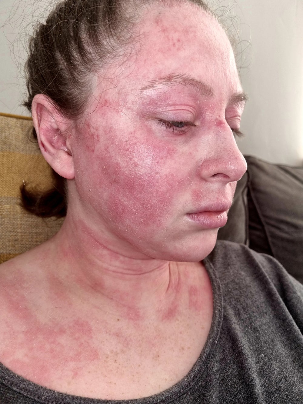 La dermatitis atópica de Kimberley le cubrió la cara y el cuello en marzo de 2020